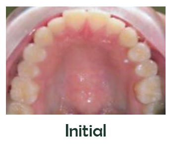 Miniscrew-Assisted Rapid Palatal Expansion (MARPE), Smile Design